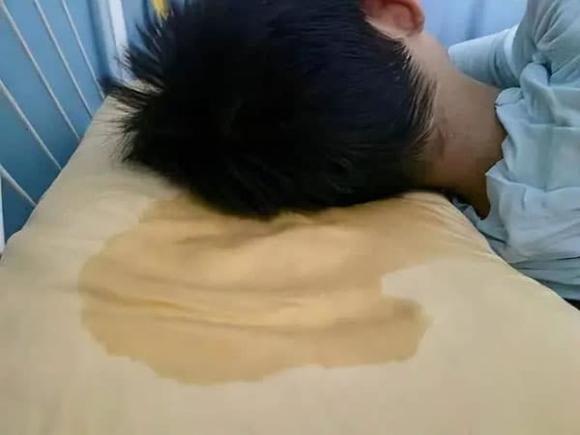 Đổ mồ hôi đêm là một hiện tượng phổ biến và thường được cho là do suy nhược cơ thể hoặc rối loạn nội tiết, đặc biệt là đối với những người ở độ tuổi trung niên.