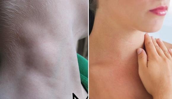 ung thư vòm họng, dấu hiệu ung thư vòm họng