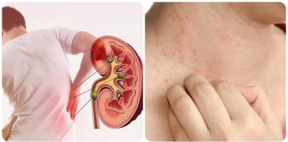 8 dấu hiệu cảnh báo suy thận giai đoạn đầu: Xem thường chạy thận cả đời