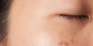 4 bất thường trên da là dấu hiệu của u-ng thư nhưng rất nhiều người KHÔNG HỀ HAY BIẾT!