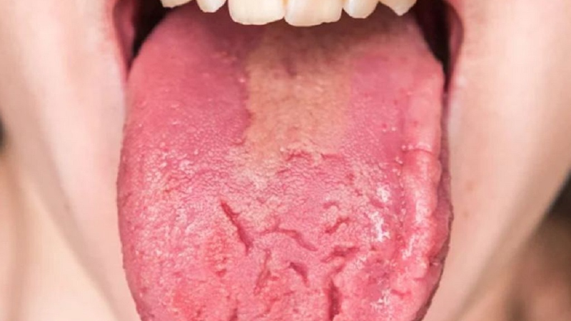 Nhìn lưỡi đoán bệnh thông qua màu sắc và bệnh lý cơ bản 4