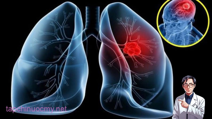 9 dấu hiệu ung thư phổi giai đoạn đầu, đừng lơ là kẻo di căn nguy hiểm
