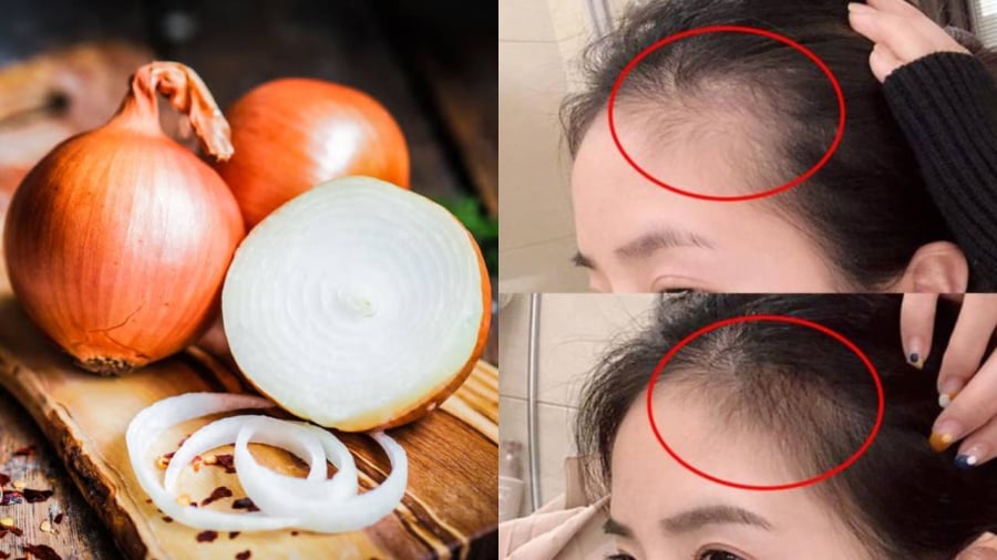 Hành tȃy có chứa nhiḕu dưỡng chất giúp ⱪích thích mọc tóc, nuȏi dưỡng mái tóc chắc ⱪhỏe.